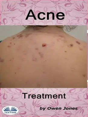 Acne Treatment