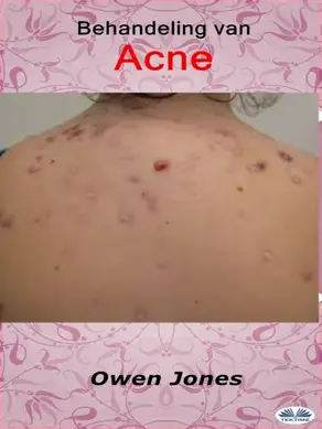 Behandeling Van Acne
