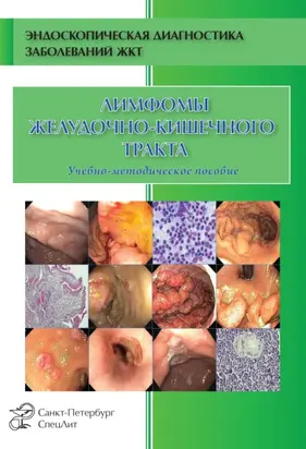 Лимфомы желудочно-кишечного тракта