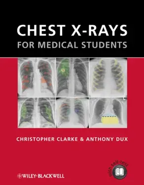 Chest X-rays for Medical Students